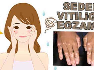vitiligo hastalığı bitkisel tedavi ibrahim saraçoğlu